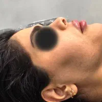 تخفیف ویژه لیزر بوتاکس فیلر پی آر پی مزو فیشیال و.