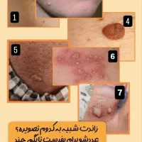 بهبود زگیل تناسلی ،تبخال تناسلی
