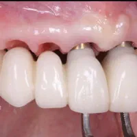 ایمپلنت با اقساط بلند مدت در تبریز|خدمات آرایشگری و زیبایی|اهر, |دیوار