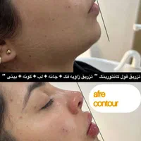 ژل و بوتاکس مرو فیلر توسط دکتر تخفیف ۳۰ ٪|خدمات آرایشگری و زیبایی|مشهد, کوثر|دیوار