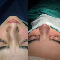 اف ویژه جراحی بینی در اهواز|خدمات آرایشگری و زیبایی|سوسنگرد, |دیوار