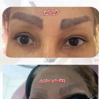 پاک کردن تاتو با دستگاه لیزر پیشرفته|خدمات آرایشگری و زیبایی|ماهدشت, |دیوار