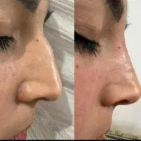 ژل و بوتاکس در منزل شما|خدمات آرایشگری و زیبایی|کرمانشاه, |دیوار