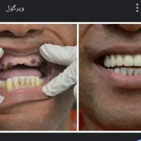 ایمپیلنت تخصصی کلینیک دندانپزشکی آرمی