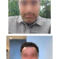 جشنواره ویژه کاشت مو و ابرو|خدمات آرایشگری و زیبایی|رشت, بوسار|دیوار