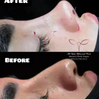 جشنواره تخفیف جراحی بینی