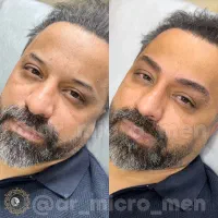 میکروبلیدینگ آقایان