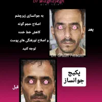 لیزر تزریق بوتاکس ژل فیلر مزوتراپی هایفو توسط پزشک|خدمات آرایشگری و زیبایی|پرند, فاز ۲|دیوار