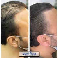 رفع کم پشتی مو با میکرو اسکالپ/ جایگزین کاشت مو|خدمات آرایشگری و زیبایی|مشهد, وکیلآباد|دیوار