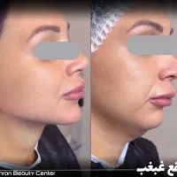 کلینیک/ جراحی بینی / ترمیم / تزریق ژل لب /|خدمات آرایشگری و زیبایی|تهران, سعادتآباد|دیوار