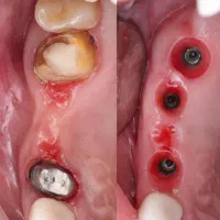 خدمات دندانپزشکی (ایمپلنت) با شرایط ویژه