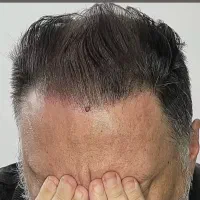 پرپشتی مو در سه روز بدون کاشتمو|خدمات آرایشگری و زیبایی|جهرم, |دیوار