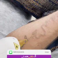 لیزر تتو و کک ومک