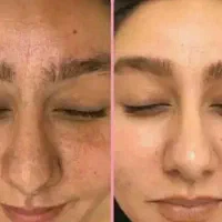 مشکلات پوستیی پسوریازیس لک و...تضمینی|آرایشی، بهداشتی، درمانی|اردبیل, |دیوار