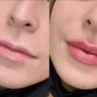 تزریق ژل .بوتاکس .انزیم بینی .مزوژل جوانساز|خدمات آرایشگری و زیبایی|جهرم, |دیوار