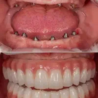 ایمپلنت دندان ویژه بازنشستگان و مستمری بگیران