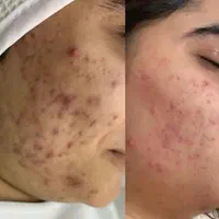آموزش،فیشیال،پاکسازی تخصصی،جوانسازی صورت بانوان|خدمات آرایشگری و زیبایی|کرمانشاه, |دیوار