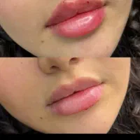 ژل ۸۵۰ بوتاکس ۱۱۰۰