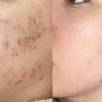 جوانسازی فیان مزو تکنیک فی پاکسازی آقا و خانوم ها|خدمات آرایشگری و زیبایی|قم, صفائیه|دیوار