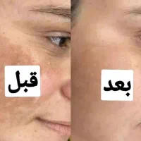 توجه توجه برداشتن خال،کک به صورت کاملا تضمینی|خدمات آرایشگری و زیبایی|تاکستان, |دیوار