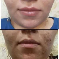 کرم ضدجوش بیوممتیک