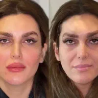 مدل رایگان آر اف جوانساز و آبرسانی برای مطب زیبایی