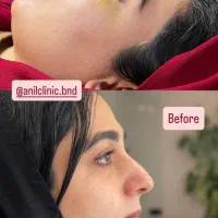 عمل زیبایی بینی با بهترین متخصص