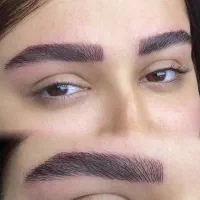 میکروبلیدینگ،شیدینگ،خط چشم،فیبروز