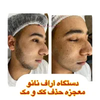 حذف کک‌و‌مک،خال در *یک جلسه*برای اولین باردر اهواز|خدمات آرایشگری و زیبایی|اهواز, کیانپارس |دیوار