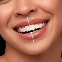 سفید کننده دندان|آرایشی، بهداشتی، درمانی|کرج, بنیاد|دیوار
