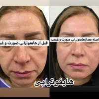 اولین مرکزتخصصی هایفو12بعدی(آراف تخصصی)خوزستان|خدمات آرایشگری و زیبایی|اهواز, زیتون کارمندی|دیوار