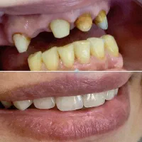 روکش بریج لمینت دندان مصنوعی(اقتصادی)