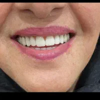پروتز دندان صدف