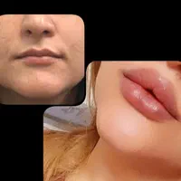 تزریق ژل وبوتاکس