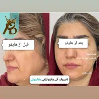 جوانسازی قوی  لیفت صورت ،روشن کننده هایفوتراپی|خدمات آرایشگری و زیبایی|یاسوج, |دیوار