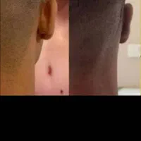 بلفا رو،بلفاروپلاستی،لیفت شقیقه،اتوپلاستی،ساکشن غب|خدمات آرایشگری و زیبایی|اهواز, نادری|دیوار
