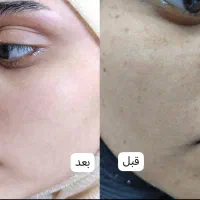 درمان ترک پا|آرایشی، بهداشتی، درمانی|شادگان, |دیوار