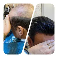 پروتز مو و تمام خدمات پروتزمو مردانه و زنانه