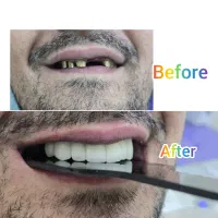 ساخت انواع دست دندان .روکش .لمینت باکیفیت بالا