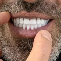 دندانسازی دندان مصنوعی طرح لمینیت اقساط چک