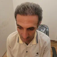 مزوتراپی/درمان ریزش موقطعی|خدمات زیبایی و سلامت|تبریز, |دیوار
