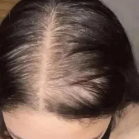 بدون کاشت پرپشت کن موهات