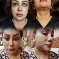 رینوپلاستی در تهران  با تخفیف ویژه تابستانه