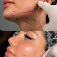سوپر کانتورینگ غبغب بینی زاویه سازی دائمی ۴۵٪تخفیف|خدمات زیبایی و سلامت|مشهد, هفت تیر (آب و برق)|دیوار