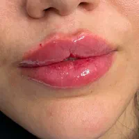 خدمات ژل فیلر بوتاکس|خدمات آرایشگری و زیبایی|هشتگرد, هشتگرد قدیم|دیوار