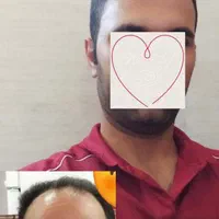 کاشت مو، ابرو، ریش حرفه ای توسط پزشک متخصص پوست مو|خدمات آرایشگری و زیبایی|شیراز, قدوسی غربی|دیوار