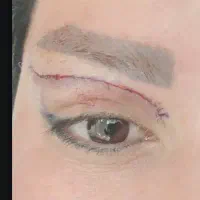 بلفارو ژل بوتاکس غبغب آنزیم|خدمات آرایشگری و زیبایی|اهواز, نادری|دیوار