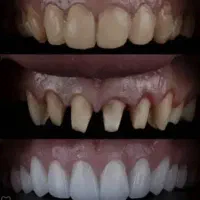 ثبت نام بیمه دندانپزشکی وکامپوزیت وزیبایی دندان|خدمات آرایشگری و زیبایی|گرگان, |دیوار