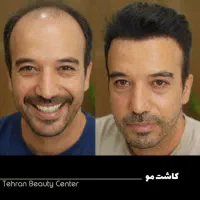 کاشت مو/تخصصی/اقساطی/ضمانت کتبی واقعی