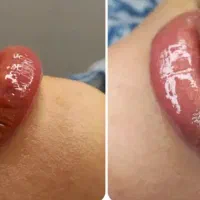 ژل لب،فیلر بوتاکس لیزر موهای زاید درمجموعه پزشکی|خدمات زیبایی و سلامت|تهران, پرستار|دیوار